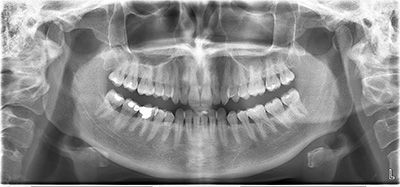 Панорамный снимок челюсти