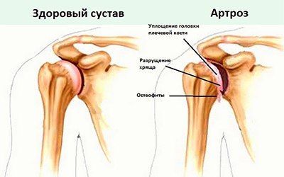 Остеоартроз плечевого сустава