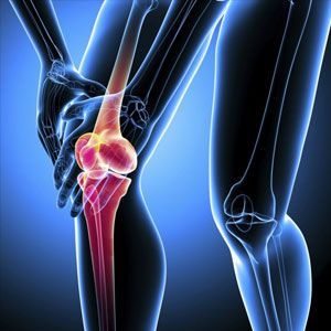 Остеоартроз коленного сустава (гонартроз)