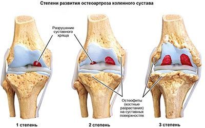 Остеоартроз