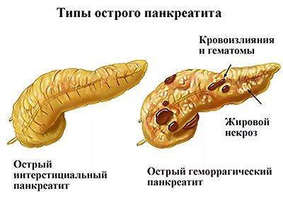 Панкреатит Фото Языка Панкреатит Фото Языка