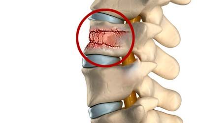 Диагностика переломов отделов позвоночника