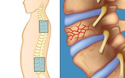 Диагностика переломов отделов позвоночника