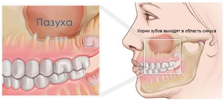 Перфорация верхнечелюстной пазухи