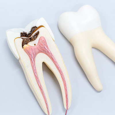 Перфорация зуба
