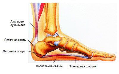 Пяточная шпора