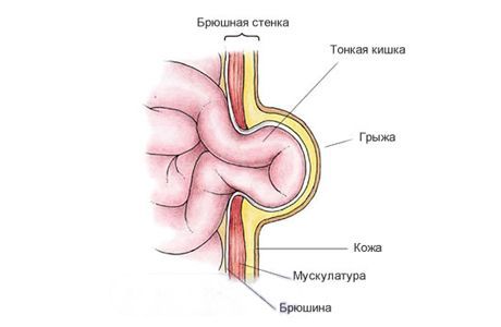 Грыжа Белой Линии Фото