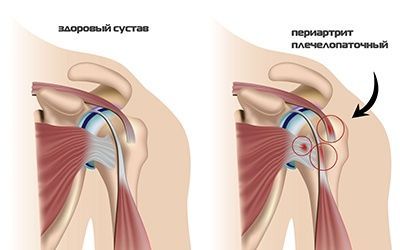 Плече-лопаточный периартрит