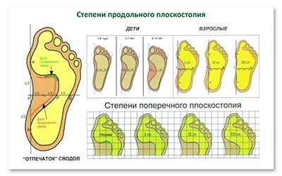 Плоскостопие