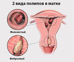 Классификация полипов матки