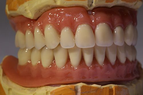 Протезирование при полной имплантации зубов