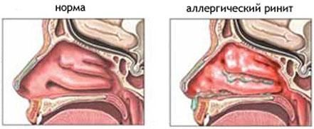 Норма и ринит