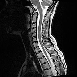 МРТ шейного отдела позвоночника