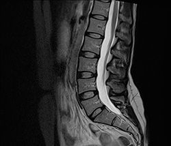 МРТ пояснично-крестцового отдела позвоночника