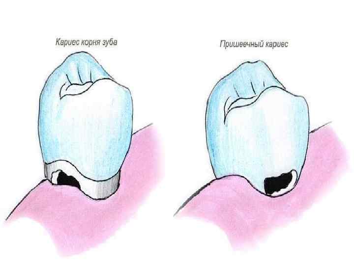 Пришеечный кариес