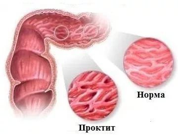 Проктит