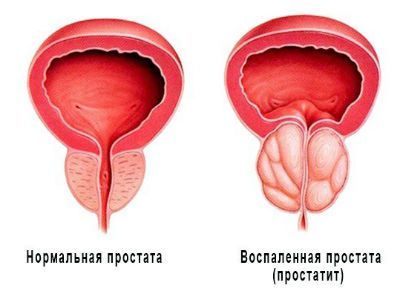 Лечение хронического простатита