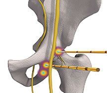 Радиочастотная денервация тазобедренного сустава