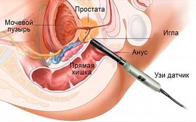 Диагностика рака предстательной железы