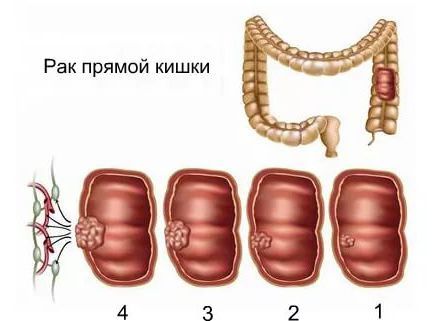 Рак прямой кишки