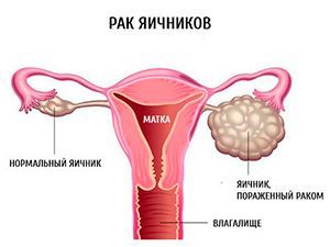 Рак яичников