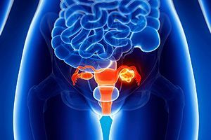 Лечение рака яичника - удаление матки с придатками