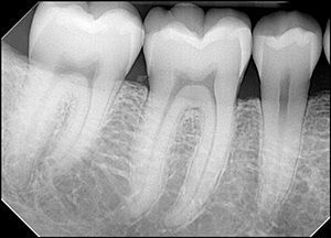 Рентгенография зубов
