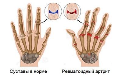 Ревматоидный артрит