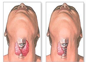 Резекция щитовидной железы