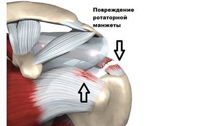 Изображение - Повреждение ротаторной манжеты плечевого сустава лечение rotatornaja-manzheta-plecha