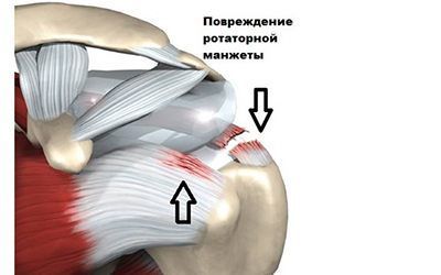 Повреждение ротаторной манжеты плеча