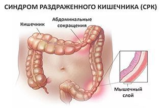 Синдром раздраженной кишки