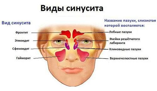 Гнойные выделения из носа