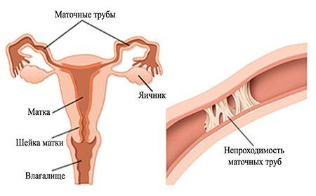 УЗИ маточных труб на проходимость