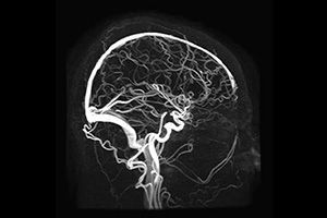 МР-ангиография сосудов головного мозга