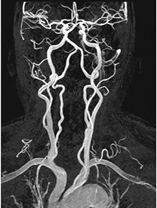 МР-ангиография сосудов шеи