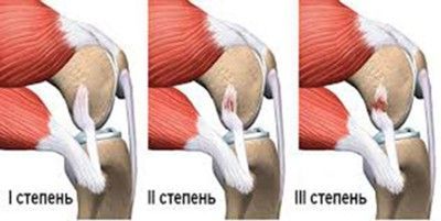 Восстановление после разрыва связок коленного сустава