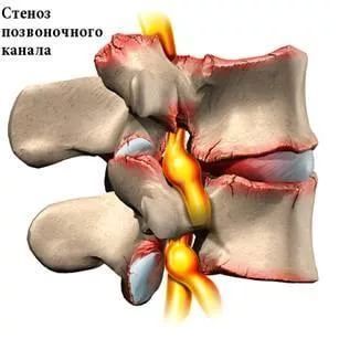 Стеноз позвоночного канала