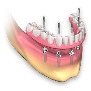 Полная имплантация зубов