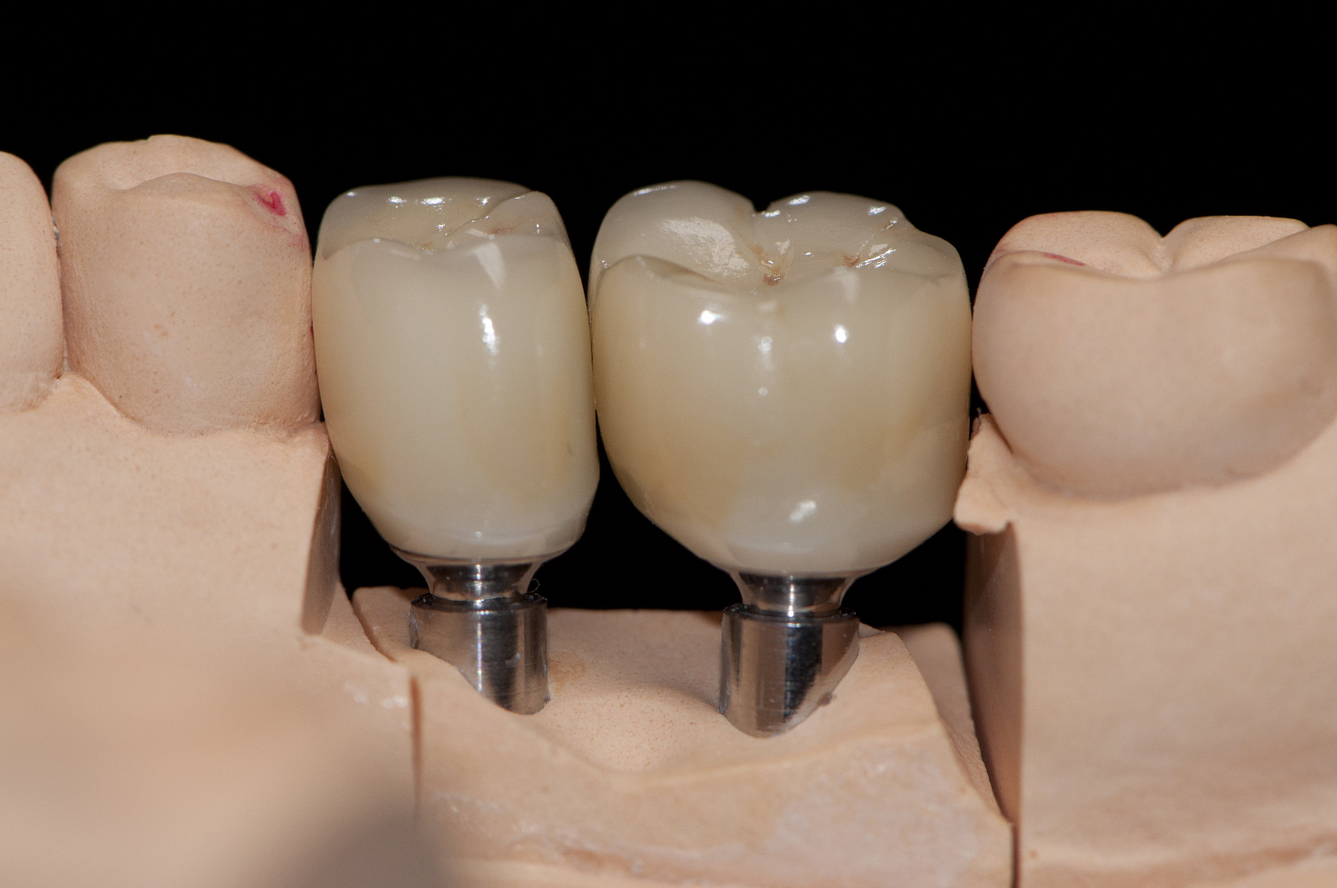Восстановление коронковой части зуба