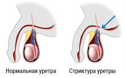 Стриктура мочеточника