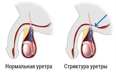 Стриктура мочеточника