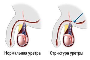 Стриктура уретры