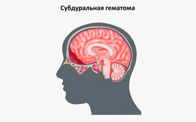 Осложнения и последствия