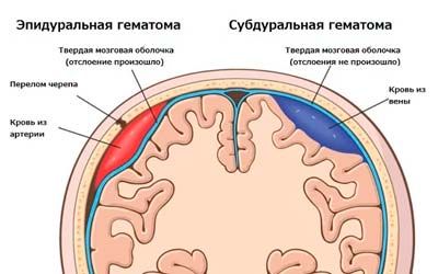 Клиника субдуральной гематомы посттравматической