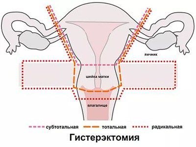 субтотальная гистерэктомия