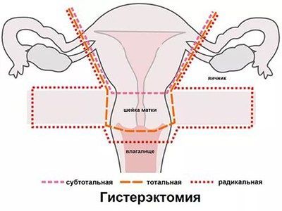 Субтотальная гистерэктомия