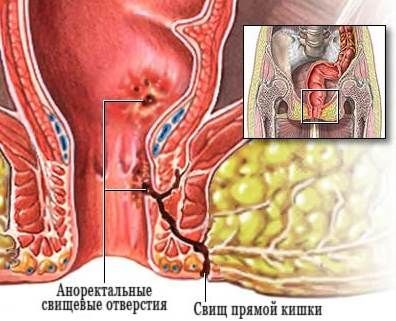 Свищ прямой кишки