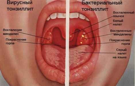 Признаки тонзиллита