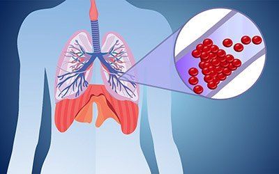 Тромбоэмболия лёгочной артерии